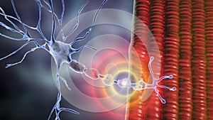 Demyelination of a neuron, the damage of the neuron myelin sheath seen in demyelinating diseases