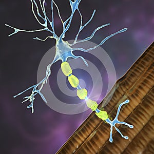 Demyelination of a neuron, the damage of the neuron myelin sheath seen in demyelinating diseases