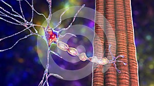 Demyelination of neuron, the damage of the neuron myelin sheath seen in demyelinating diseases