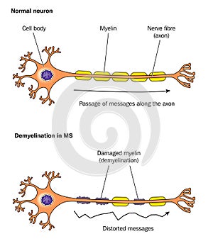 Demyelinisation