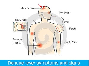 Dengue fever symptoms and signs photo