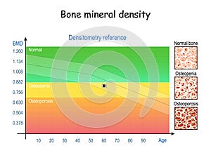 Densitometry reference. Osteopenia and osteoporosis. Aging process