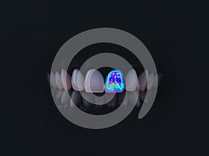 Dental Art. CloseUp of Teeth with a Vibrant, Colorful BrainInspired Crown photo