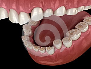 Dental attrition Bruxism resulting in loss of tooth tissue.  Medically accurate tooth