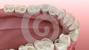 Dental attrition Bruxism resulting in loss of tooth tissue.  Medically accurate tooth 3D animation
