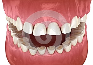 Dental attrition Bruxism resulting in loss of tooth tissue.  Medically accurate tooth 3D illustration