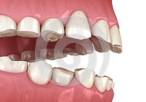 Dental attrition Bruxism resulting in loss of tooth tissue.  Medically accurate tooth 3D illustration