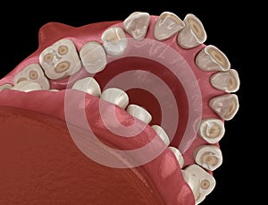 Dental attrition Bruxism resulting in loss of tooth tissue.  Medically accurate tooth 3D illustration