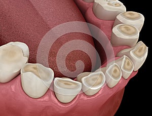 Dental attrition Bruxism resulting in loss of tooth tissue.  Medically accurate tooth 3D illustration