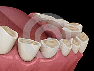 Dental attrition Bruxism resulting in loss of tooth tissue.  Medically accurate tooth 3D illustration