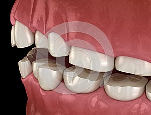 Dental attrition Bruxism resulting in loss of tooth tissue.  Medically accurate tooth illustration