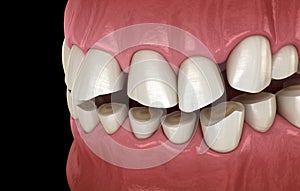 Dental attrition Bruxism resulting in loss of tooth tissue.  Medically accurate tooth illustration