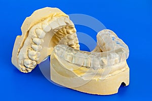 Dental bite with chalk model