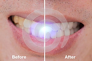 Before and After of dental bleaching in male whitening teeth for remove coffee or cigarette stains