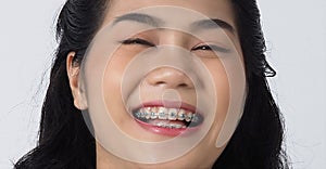 Dental brace teen girl smiling looking on a camera