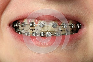 Dental Braces