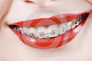 Zubná traky 