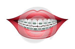 Dental Braces