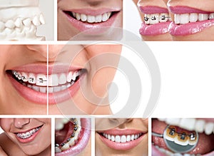 Dental braces