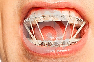 Dental braces with orthodontic latex rings on photo