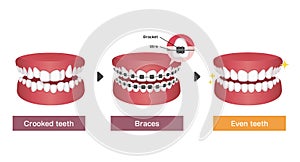 Dental braces process vector illustration