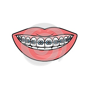 Dental braces schematic medical illustration