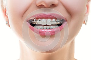 Dental Braces on Teeth