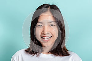 Dental braces of young asian woman wearing braces beauty smile with white teeth