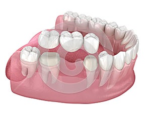 Dental bridge of 3 teeth over molar and premolar. Medically accurate 3D illustration of human teeth treatment