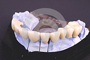 Dental bridge