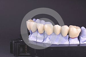 Dental bridge