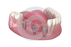 Dental bridge based on 3 implants. Medically accurate 3D illustration of human teeth and dentures concept