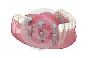 Dental bridge based on 3 implants. Medically accurate 3D illustration of human teeth and dentures concept