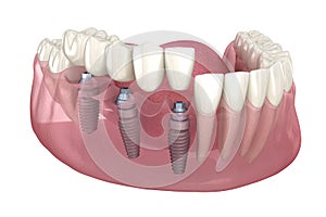 Dental bridge based on 3 implants. Medically accurate 3D illustration of human teeth and dentures concept