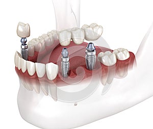 Dental bridge and crown placement over implants. Dental 3D animation concept