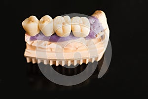 Dental bridge made of porcelain on casting