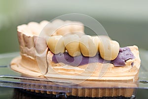 Dental bridge made of porcelain on casting