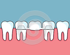 Dental bridge and row of teeth