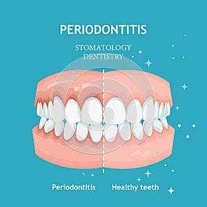 Periodontitis vector. Recession gums treatment. Stomatology dentistry concept photo