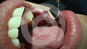 Dental Care Extreme Close up Macro Video. Dentist treat patient teeth. Orthodontist works with microscope and dental