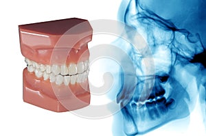 Dental care: invisible orthodontic aligner and cephalometric x-ray photo
