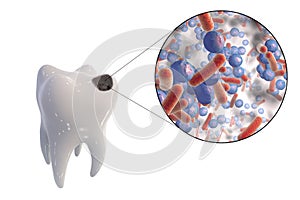 Dental caries and close-up view of microbes which cause caries