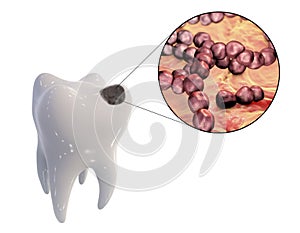 Dental caries and close-up view of microbes which cause caries