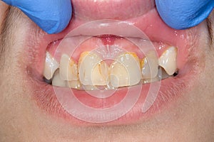 Dental caries. Filling with dental composite photopolymer material using rabbders. Concept of dental treatment in dental clinic photo