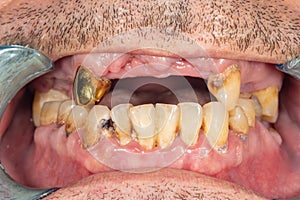 Dental caries. Filling with dental composite photopolymer material using rabbders. The concept of dental treatment in a dental photo