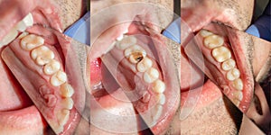 Dental caries. Filling with dental composite photopolymer material using rabbders. The concept of dental treatment in a dental