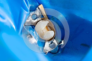 Dental caries. Filling with dental composite photopolymer material using rabbders. The concept of dental treatment in a dental