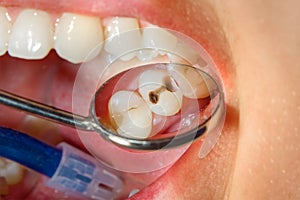 Dental caries. Filling with dental composite photopolymer material using rabbders. Concept of dental treatment in dental clinic