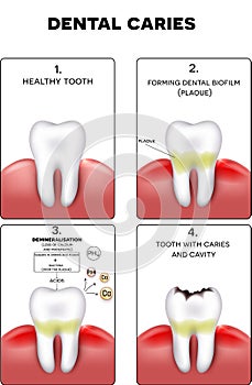 Dental caries formation