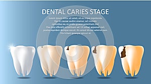 Dental caries stages vector medical poster banner template